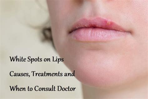 White Spots On Lips Causes Treatments And When To Consult Doctor