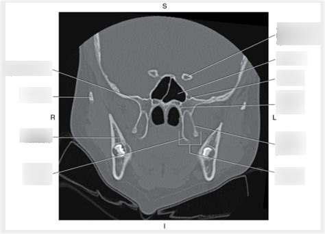 Coronal Ct Of Sphenoid Bone Diagram Quizlet