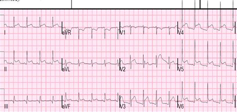 Webmd provides myocarditis information including symptoms, causes, treatments, types, and myocarditis often has no symptoms. Dr. Smith's ECG Blog: ECG of pneumopericardium and probable myocardial contusion shows typical ...