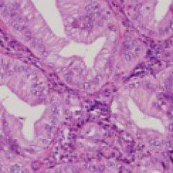 Maybe you would like to learn more about one of these? Epithelioid Mesothelioma: Epithelial Cell Prognosis ...