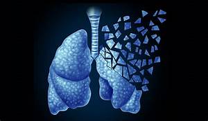 Lung cancer survival rates improve with CT scan follow-up Lung Cancer  