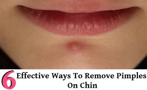 6 Effective Ways To Remove Pimples On Chin Howtogetridofpimples
