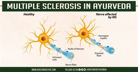 Multiple Sclerosis In Ayurveda Health Reactive Body Revival