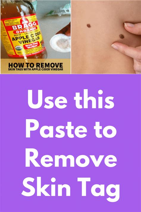 how to remove skin tags using home remedies
