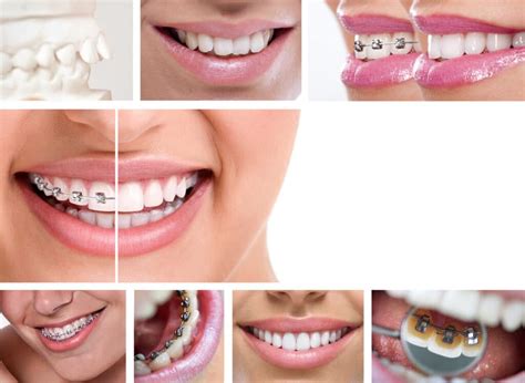 Aparelho Lingual Antes E Depois
