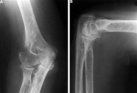 Valgus Deformity And Proximal Subluxation Of The Rheumatoid Elbow A