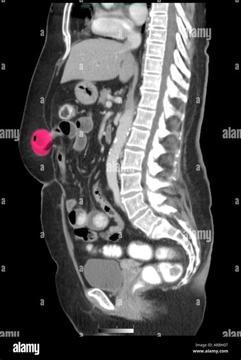 Ct Scan Sagittal View Showing An Abdominal Wall Hernia Stock Photo