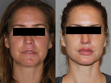 Facial Rejuvenation Before And After Pictures Case 147 Atlanta