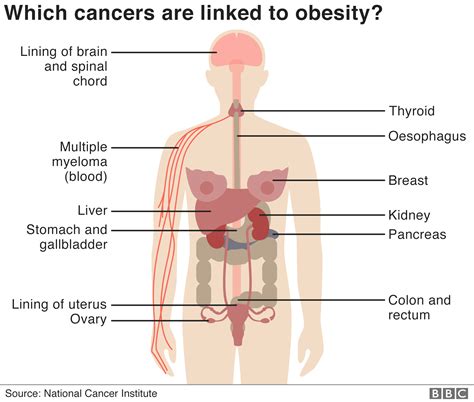 Obesity Causes More Cases Of Some Cancers Than Smoking Bbc News
