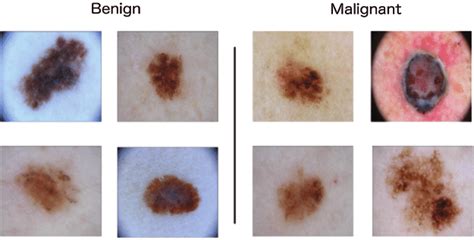 Benign And Malignant Melanoma Sample Images Download Scientific Diagram