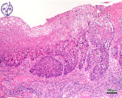 Esophageal Squamous Cell Carcinoma Histology