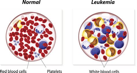 Co To Jest Zespol Hemofagocytowy Objawy Przyczyny I Sposoby Leczenia