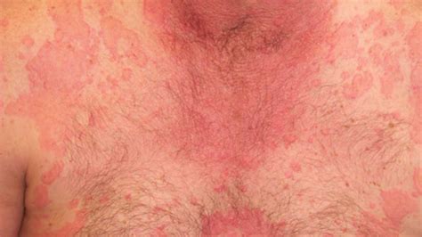 Mireworks Design Can Seasonal Allergies Cause Itchy Skin