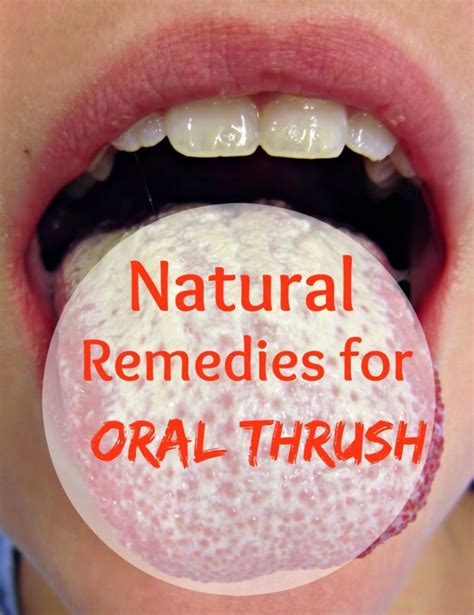 Natural Remedies For Oral Thrush Healthmix Info