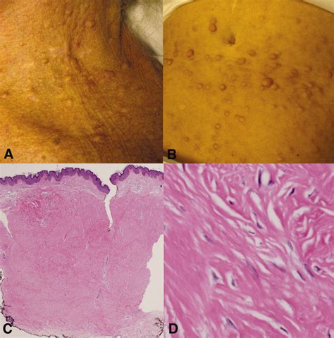 Nodularkeloidal Scleroderma Acquired Collagenous Nodules In Systemic