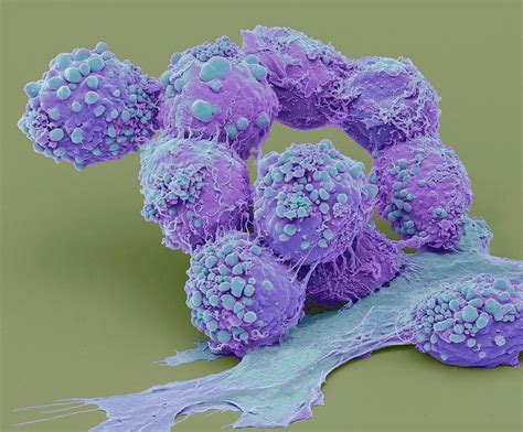 Brain Cancer Cells Photograph By Steve Gschmeissner