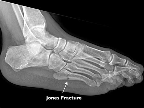 What Exactly Is A Jones Fracture Foot And Why Might It Need Surgery