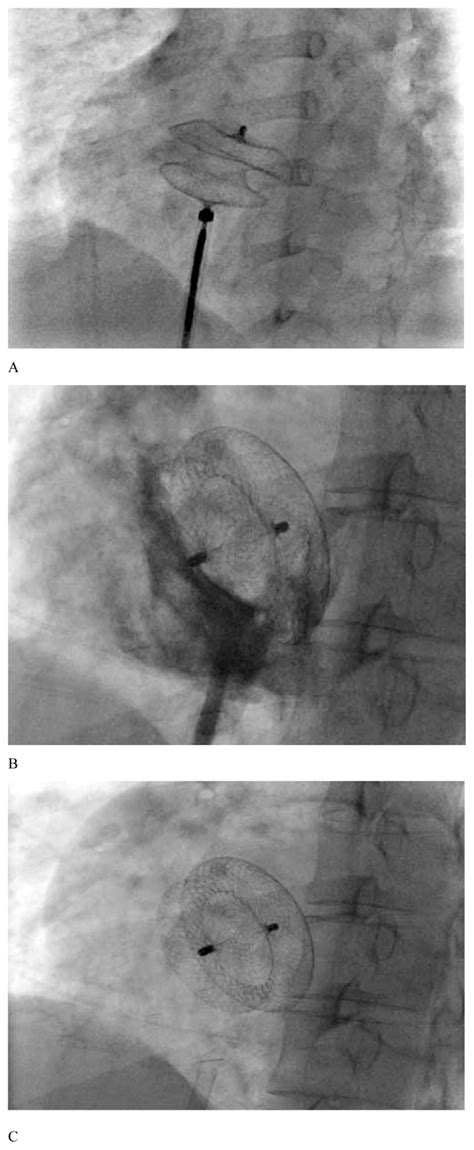 Transcatheter Closure Steps By Fluoroscopy Deployment Of The Left And