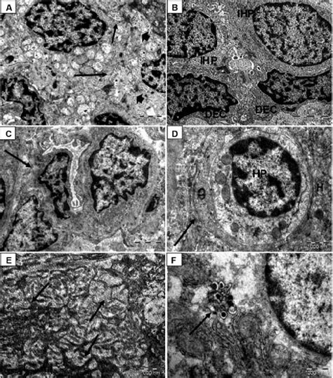 Electron Micrographs Of Liver Sections Demonstrating Pathological