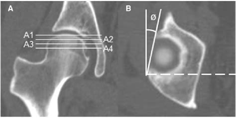 Measurement Of The Acetabular Version Angle In Four Axial Slices A