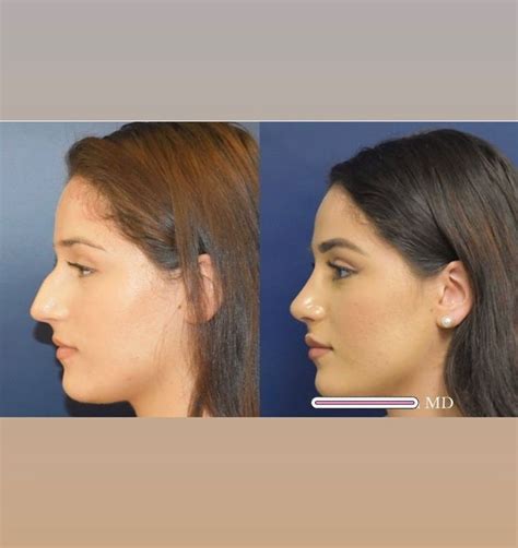 Pin By Sara Og812 On Nose In 2020 Nose Plastic Surgery Perfect Nose Nose Contouring