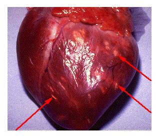 Symptoms of myocarditis include chest pain, shortness of breath, fatigue, and fluid accumulation in the lungs. Myocarditis. Causes, symptoms, treatment Myocarditis
