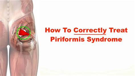 Piriformis Syndrome And Acupuncture Ponsonby Wellness