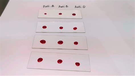 Blood Typing Rh Positive Slide Agglutination Test Medical Laboratory Science Youtube