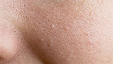 Why We Get Little White Dots Under Our Skin Wyza