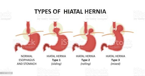 Types Of Hiatal Hernia Stock Illustration Download Image Now Istock