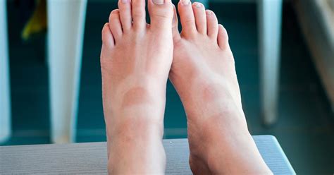 Swollen Feet From Sunburn Home Remedies And When To Seek Medical Help