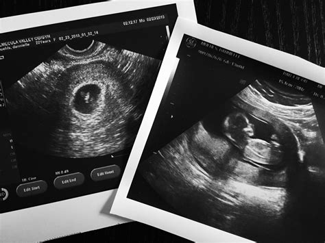 13 Weeks Pregnant Ultrasound Girl