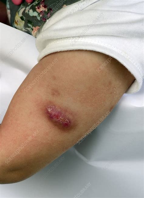Bcg Keloid Scar Stock Image C0180965 Science Photo Library