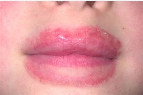 Gebrochene Lippen Und Hautausschlag Um Den Mund Bioforkids