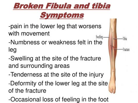Ppt Fracture Of Fibula And Tibia Powerpoint Presentation Free 865