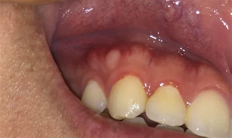 White Bump On Gums It Is Not Painful And Feels Hard Just Appeared