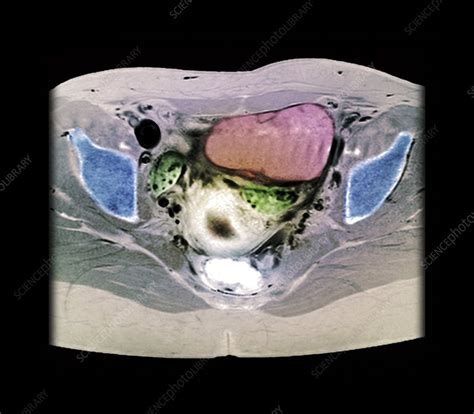 Ovarian Cyst X Ray Stock Image C0133029 Science Photo Library