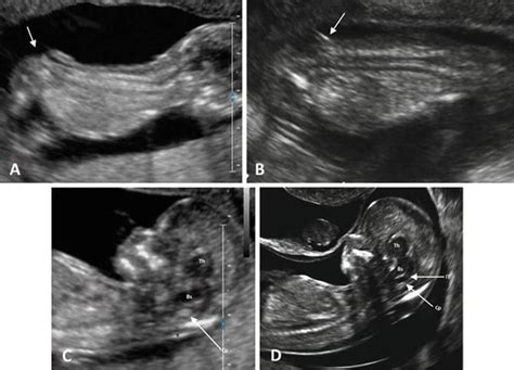 Fetal Anomalies First Trimester Ultrasound A Comprehensive Guide 43200