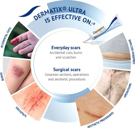 But now after trying the dermatix acne scar gel dermatix is a scra reduction gel which comes in gel and silicone sheet form. Dermatix® Ultra | Dermatix® Hong Kong