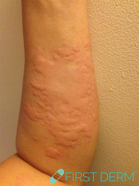 Skin Rash Pictures Causes And Treatment