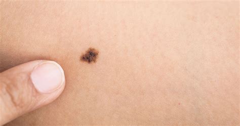 Signs Of Cancerous Moles Baptist Health
