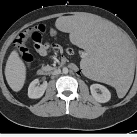 Ct Abdomen And Pelvis With Iv Contrast Demonstrating Splenomegaly With