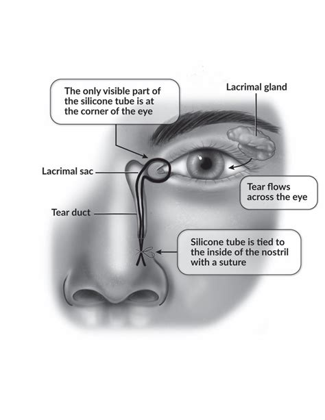 Blocked Tear Duct And Siicone Intubation Health And Nutrition Facts