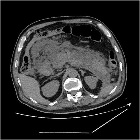 Abdominal Ct Showed Diffuse Enlargement Of The Pancreas And Extensive