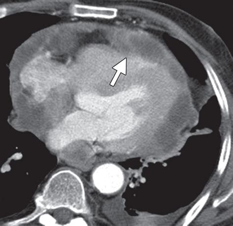 Primary Pericardial Tumors Radiographics