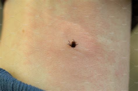 The Tick Will Tick Off Human Blood The Tick Is Under The Human Skin
