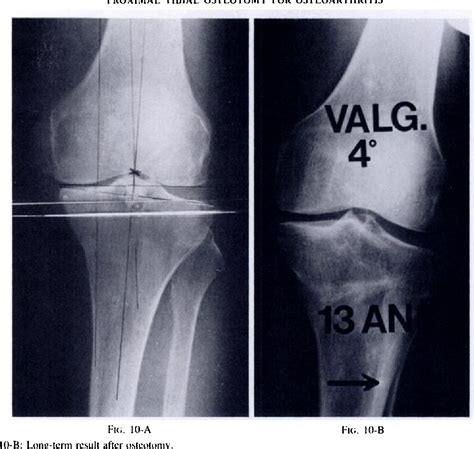 Proximal Tibial Osteotomy For Osteoarthritis With Varus Deformity A