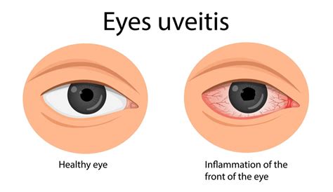 Uveitis Guide Types Symptoms Causes And Treatments