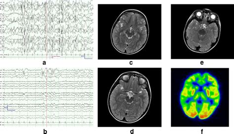 A Interictal Eeg Showing Diffuse Epileptic Encephalopathy During