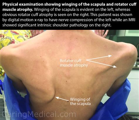 Snapping Scapula Syndrome Non Surgical Options Caring Medical Florida